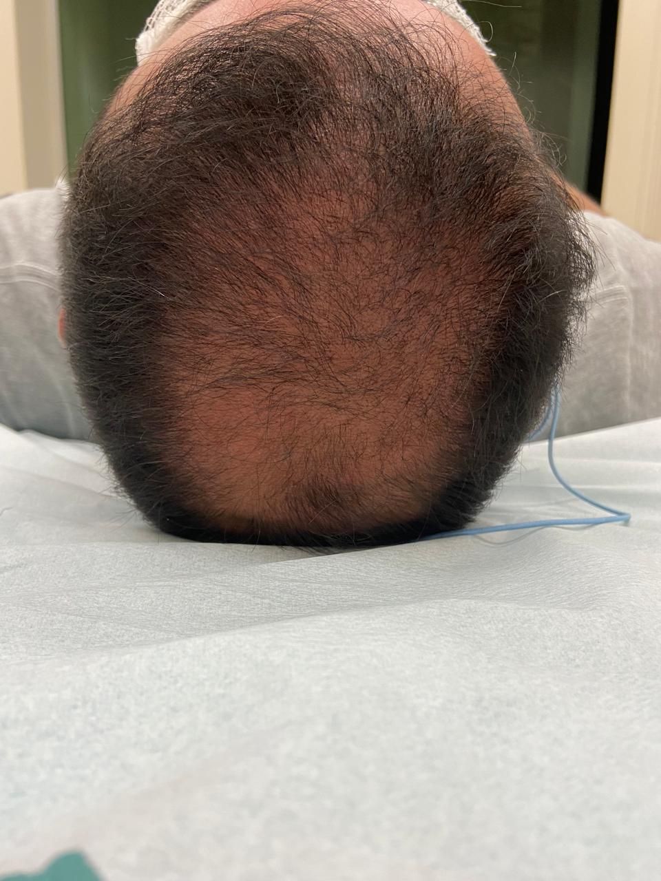 Antes e depois de protocolo capilar realizado por Jéssica Bordignon — antes