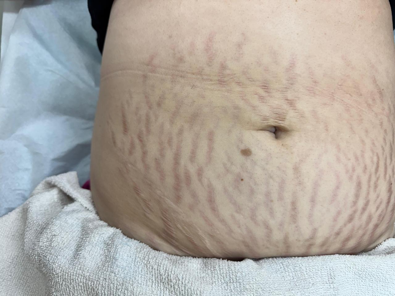 Antes e depois de tratamento de estrias realizado por Jéssica Bordignon — antes