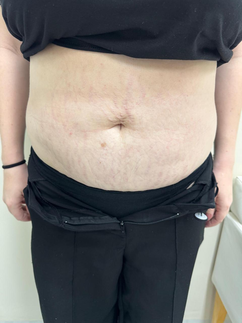 Antes e depois de tratamento de estrias realizado por Jéssica Bordignon — depois