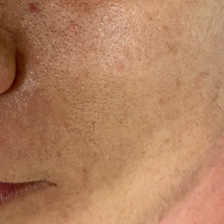 Antes e depois de protocolo para renovação da pele realizado por Jéssica Bordignon — antes