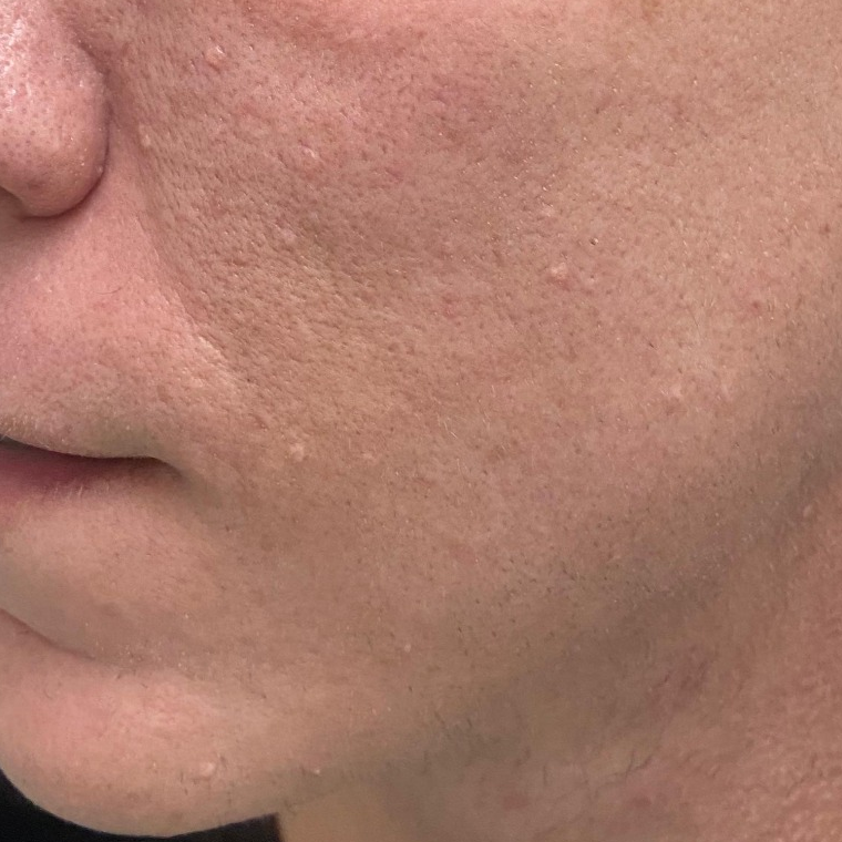 Antes e depois de protocolo para renovação da pele realizado por Jéssica Bordignon — depois