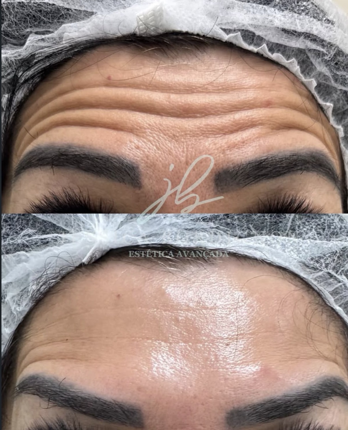 Resultado de tratamento facial realizado por Jéssica Bordignon